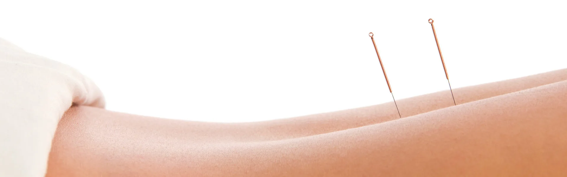 Two acupuncture needles inserted into the forearm against a clean white background